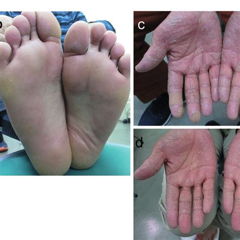 A Hyperkeratotic Skin Lesions On The Soles In Case 3 B Apremilast