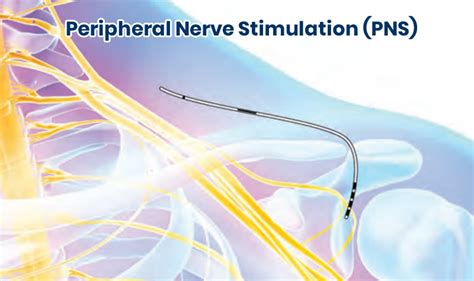 Peripheral Nerve Stimulation PNS Dr Robert Ycaza Bradenton Pain