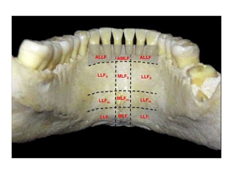 Image Of The Lingual Face Of The Anterior Mandibular Region Showing