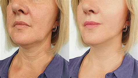 Botox For Jowls Before And After