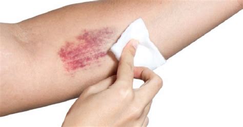 Treatment Of And Response To Cuts And Bruises