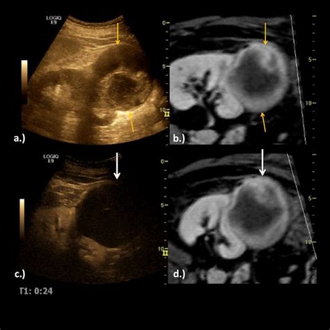 Real­time Side­by­side Image Fusion Of A Renal Cyst Yellow Arrows