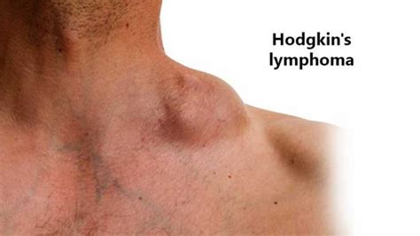 Some Facts About Hodgkin Lymphoma Entirely Health