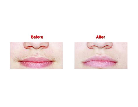 Laser hair removal neck before and after. Laser Hair Removal - Before and After Photos | Cosmetic Clinic