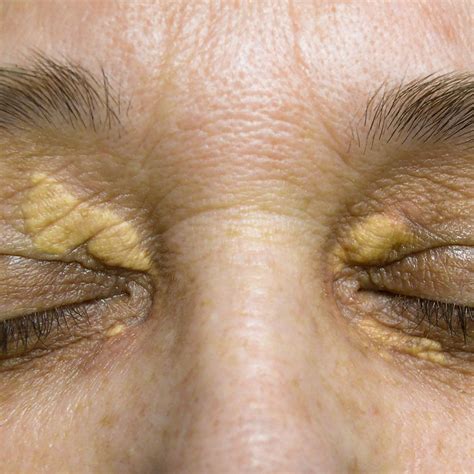 Xanthelasma Removal Brisbane Yellow Bumps On Eyelid Treatment