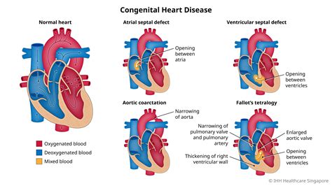 Congenital Heart Disease Chd Symptoms And Causes Parkway Shenton