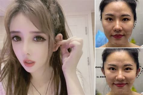 Elf Ears Are The Creepy New Plastic Surgery Trend In China Planet Concerns