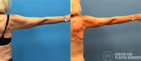 Arm Lift Before And After Photos Patient 80 Annandale