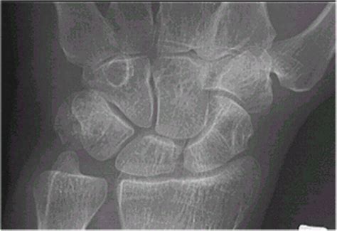 Pisiform Fracture