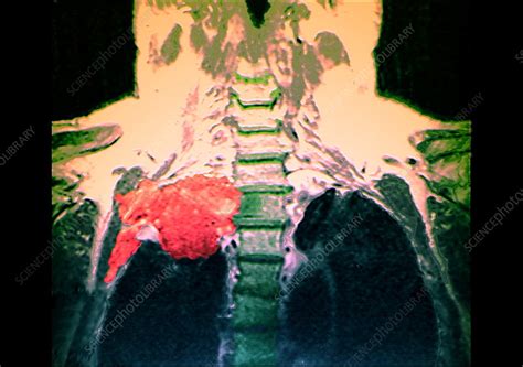 Lung Cancer Mri Stock Image M1340409 Science Photo Library