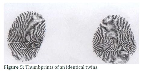 Monozygotic And Dizygotic Twins Differences In Fingerprint Patterns Of Swat District