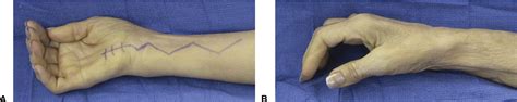 Supercharged End To Side Anterior Interosseous To Ulnar Motor Nerve
