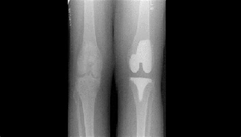 Ortho Dx Knee Pain And Joint Effusion Years After Tka Clinical Advisor