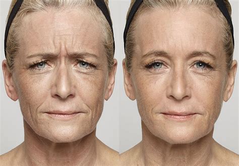 Anti Wrinkle Injections Brunswick Melbourne Non Surgical Face Lift
