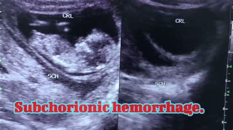 Subchorionic Hemorrhage In First Trimester Youtube
