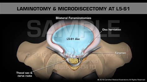 Laminotomy And Microdiscectomy At L5 S1 Youtube