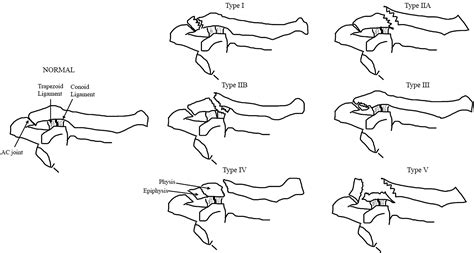 Classification Of Distal Clavicle Fractures And Indications For
