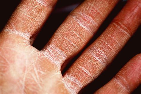 Eczema Reasons Signs And Symptoms Therapy Ohio Id