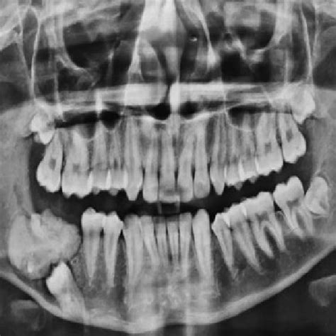 6 A Clinical Image Showing Swelling Right Body Mandible B Opg