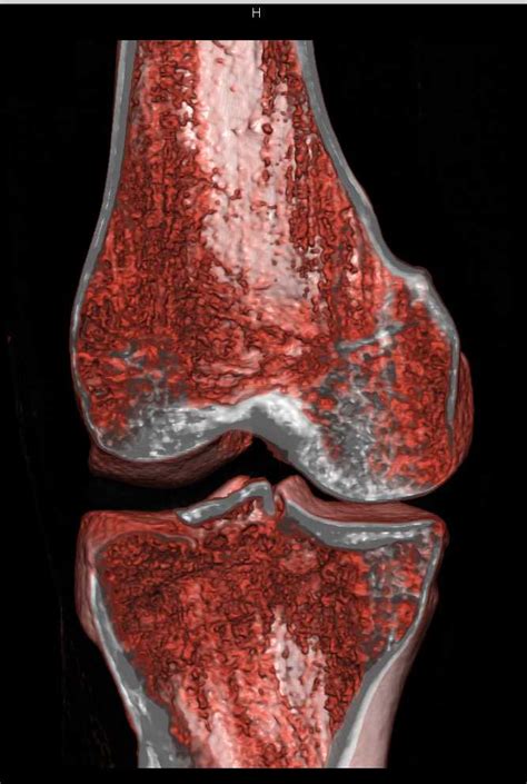Tibial Plateau Fracture Musculoskeletal Case Studies Ctisus Ct Scanning