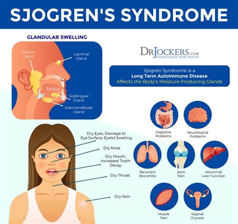 Sjogrens Syndrome Symptoms Causes And Natural Support Strategies