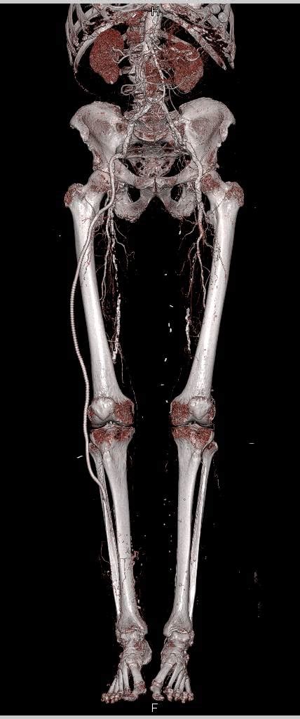 Peripheral Vascular Disease Pvd With Graft From Superficial Femoral