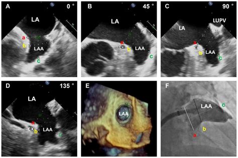 Role Of Real Timethree Dimensional Transesophageal Echocardiography In