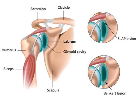 The shoulder has a wider and more varied range of motion than any other joint in the body. Labral Tears — Dr. Tyler Marshall, M.D. shoulder and sports medicine Birmingham, AL