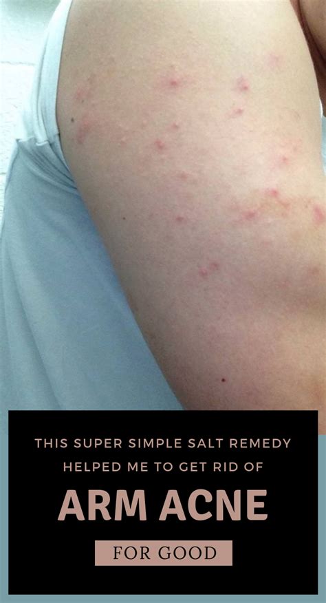 This Super Simple Salt Remedy Helped Me To Get Rid Of Arm Acne For Good
