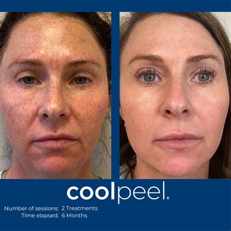 Tetra Co2 Coolpeel Rejuv Spa And Cosmetic Center