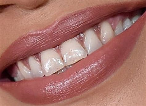 Rihanna Teeth Pictures