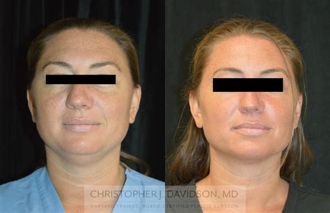 Liposuction For Boston And Wellesley Ma Dr Christopher J Davidson