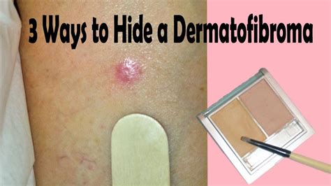 3 Ways To Hide A Dermatofibroma Youtube