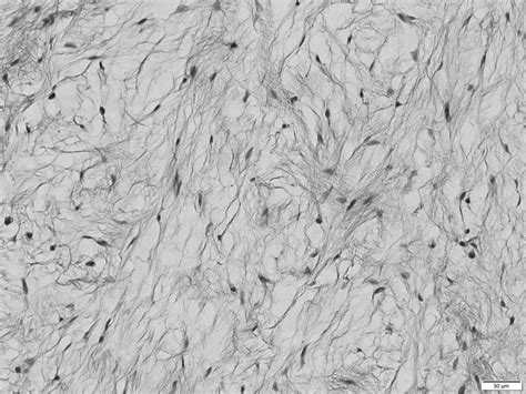 Histopathological Image Showing Abundant Myxoid Tissue Download