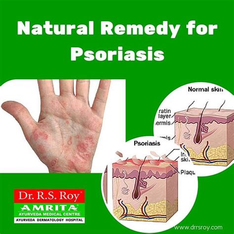 Fight Against Psoriasis With Ayurveda Total Elimination Plan For