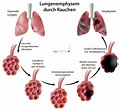 Emphysem » Formen, Ursachen, Anzeichen und Behandlung