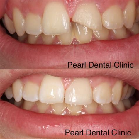 Repairing Chipped Teeth Pearl Dental Clinic Kingston London