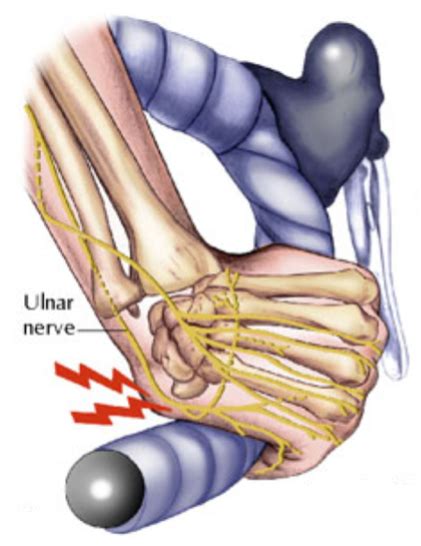 Compression Of The Ulnar Nerve Specialists On Hand