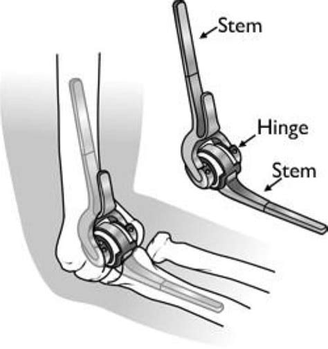 Elbow Replacement Las Vegas Orthopedic Surgeons Bone And Joint