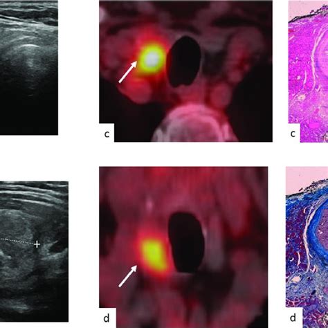 Neck Us Showed A 22 Mm Hypoechoic Solid Nodule Of The Right Thyroid