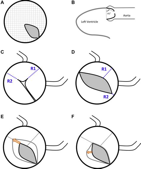 Relation of Aortic Valve Morphologic Characteristics to Aortic Valve