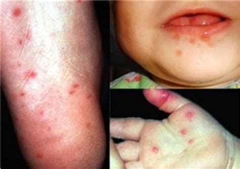 Vesicles On The Foot Mouth And Palm Area Of Children Infected With
