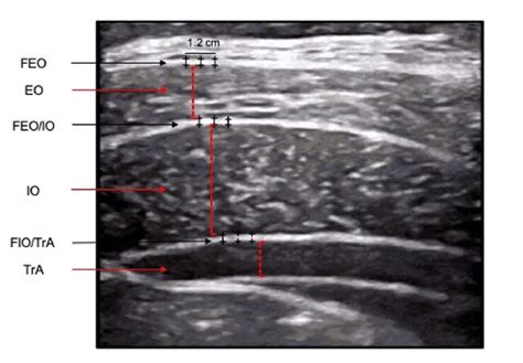 Ultrasound Image Of The Three Abdominal Muscles And Their Associated