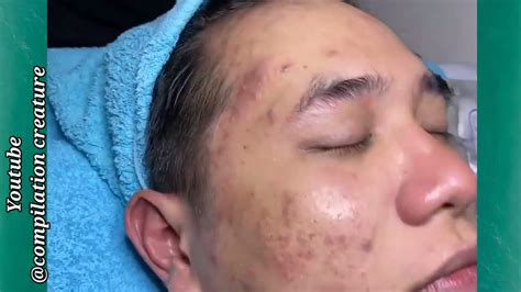 Satisfying Pimple Popping Compilation Video 2022 Satisfying