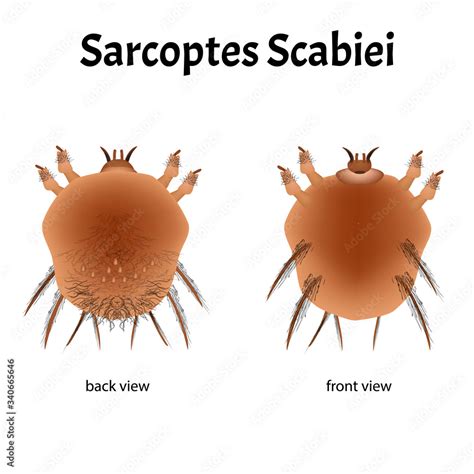 Sarcoptes Scabiei Scabies Sexually Transmitted Disease Infographics