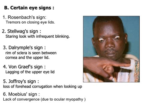 Eye Signs In Graves Disease World Surgery Forum