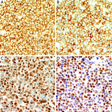 Mantle Cell Lymphoma With Plasmacytic Differentiation A Mantle Cell