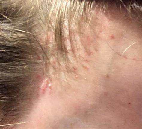 Dermatologist Couldnt Help Non Itchy Red Bumps On Scalp Dermatology