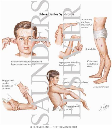 Ehlers Danlos Syndrome Is The Name Given To A Group Of Conditions That