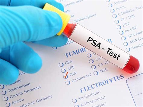 Prostate cancer is the most common form of cancer in men. Prostate-Specific Antigen (PSA) Test - National Cancer ...